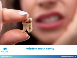 What causes a wisdom tooth cavity? Safe treatment solution
