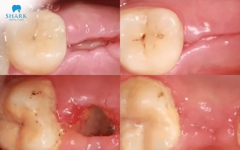 The healing time after tooth extraction will vary from person to person, depending on the condition of the tooth and each individual’s healing ability and physical condition