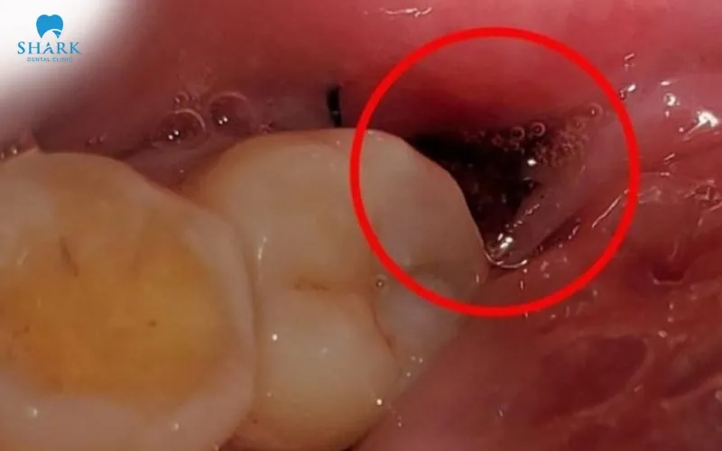 The first week after tooth extraction is an important stage in wisdom tooth extraction recovery, as the body begins forming a blood clot to protect the extraction socket and support the healing process