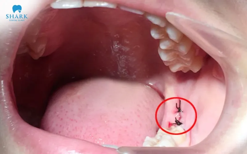During the second week, the dissolvable stitches gradually begin to disappear, while the wound continues to stabilize and heal further