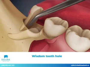 What is a wisdom tooth hole and what causes it to form?