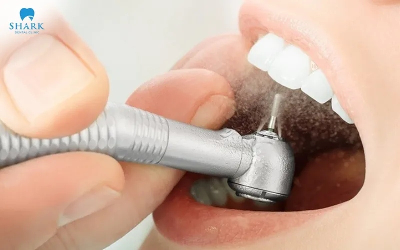 A permanently cemented porcelain crown can be filed down in certain situations where adjustment is clinically necessary