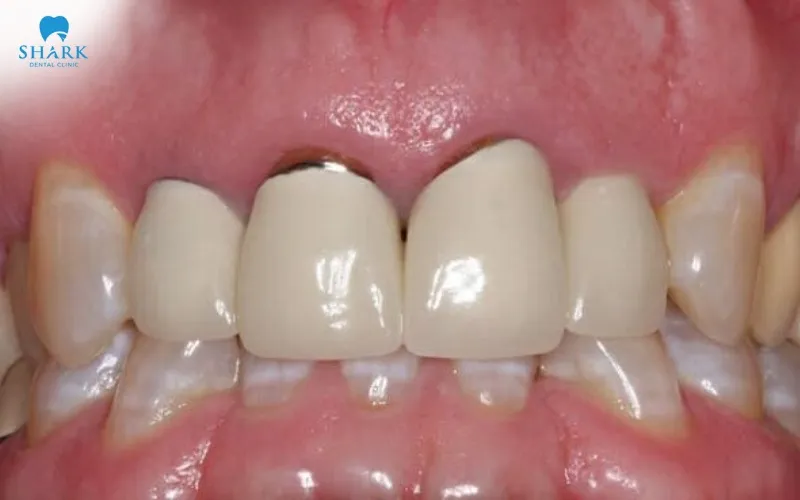 If the chewing surface of a porcelain crown is excessively thick and causes discomfort or a bulky feeling during daily use, the crown may be carefully filed down to provide a more comfortable and natural bite