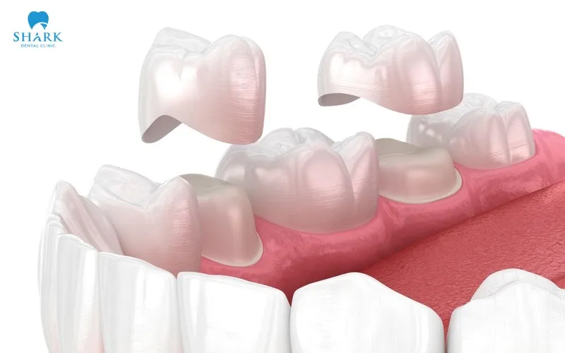 A temporary dental crown not only protects the prepared natural tooth but also allows the dentist to evaluate your comfort, bite, and overall adaptation before the permanent crown is placed