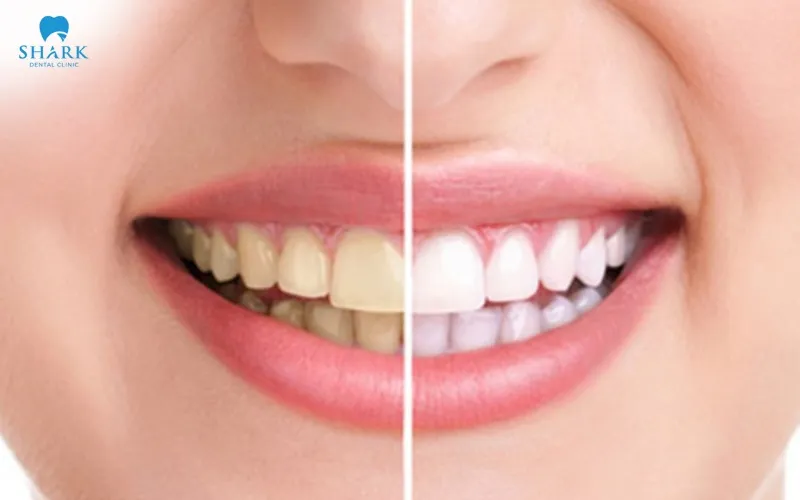 Yes, you can whiten porcelain crowns, but whitening should only be performed using professional whitening methods that are specifically recommended and carried out under the guidance of a qualified dentist