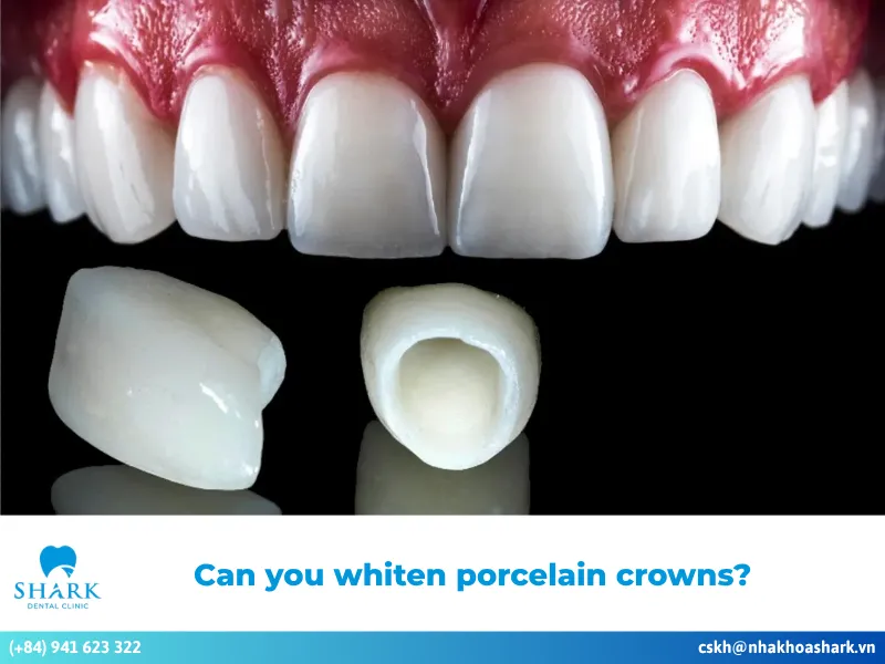 Can you whiten porcelain crowns? Effective whitening methods