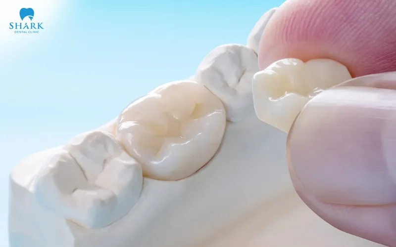To ensure that a porcelain crown remains securely attached and functions reliably over the long term, dentists generally aim to preserve as much healthy natural tooth structure as possible during tooth preparation