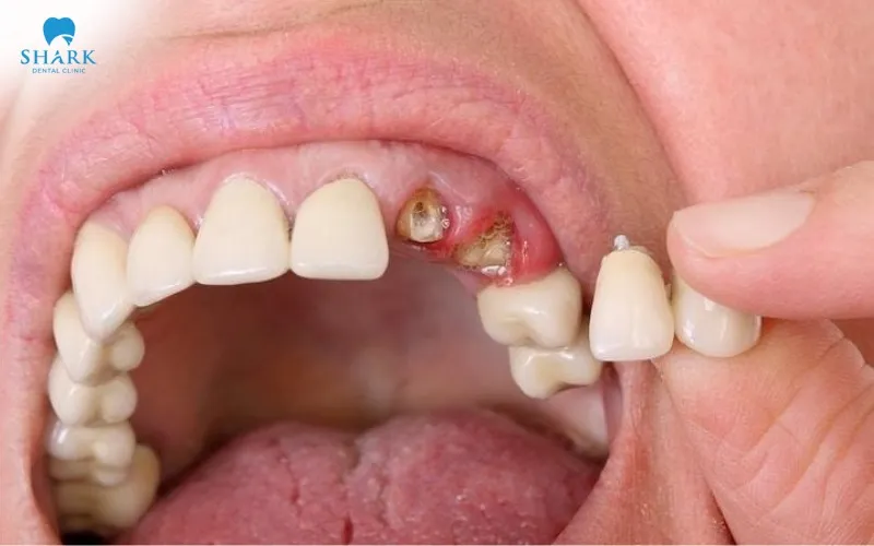 When a dental crown falls out, the exposed gum area becomes more sensitive and vulnerable to bacterial infection, so it is important to maintain careful and proper oral care to reduce the risk of complications