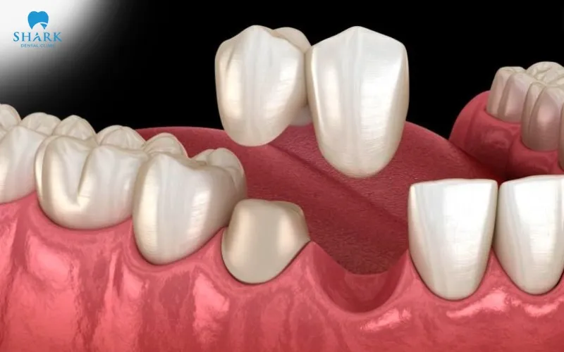 When there is no natural tooth remaining beneath the crown, it is not possible to simply reattach or place the dental crown back into position