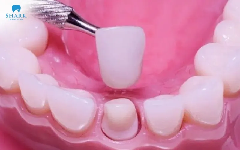 If your dental crown accidentally falls out, do not attempt to reattach it yourself, as doing so may increase the risk of bacterial contamination and could complicate subsequent dental treatment