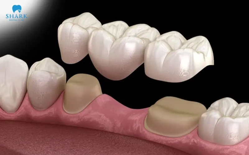 A dental bridge is an appropriate option for patients who do not wish to undergo dental implant surgery or are not suitable candidates for implant treatment