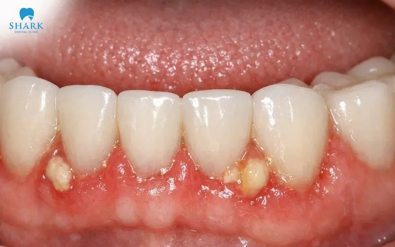 When bacteria enter the inside of the tooth through small gaps or cracks, an infection may develop and lead to severe tooth pain