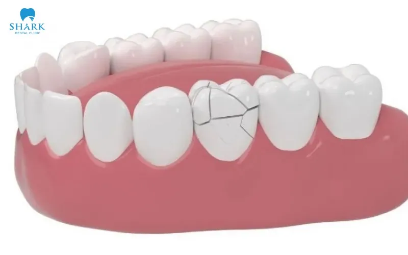 During use, a dental crown may become cracked, chipped, or broken due to a variety of different causes