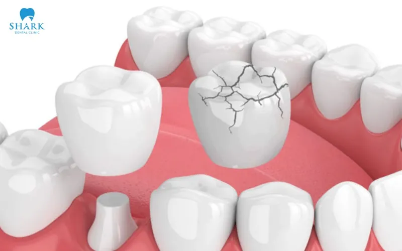 If the dental crown is severely broken, significantly deformed, or the underlying natural tooth has extensive decay or serious damage, replacing it with a new dental crown is generally the more appropriate treatment option