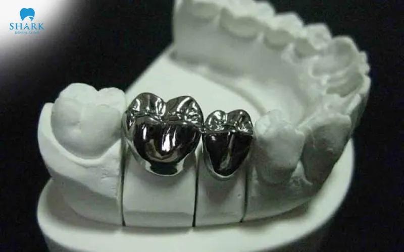 This restoration method is designed to restore the natural shape of the tooth, recover normal chewing function, and protect teeth that have been damaged by tooth decay, fractures, or chipping