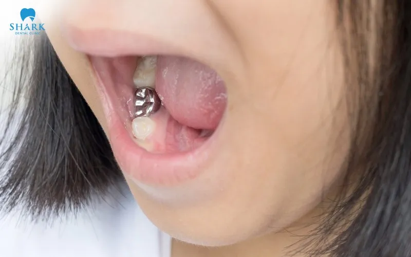 The metallic color of a silver crown tooth is easily noticeable when smiling or speaking, making it less suitable for restoring front teeth where aesthetics are a primary concern