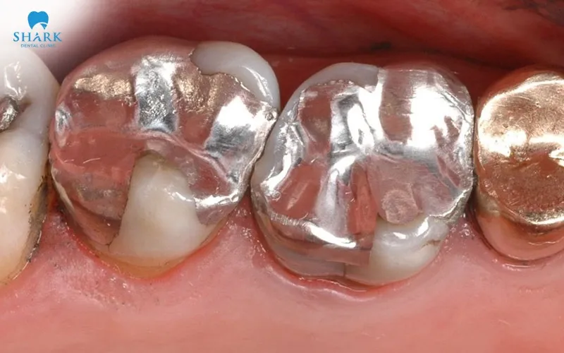 A silver crown tooth is typically fabricated from stainless steel or dental alloys containing chromium, nickel, and iron, providing enhanced strength, durability, and resistance to chewing forces