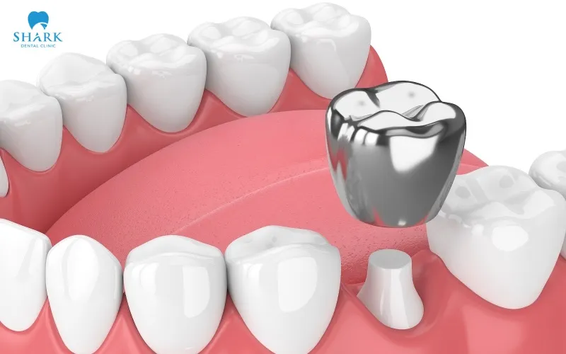 Once the dental crown has been completed, the dentist will carefully check its fit, color, and bite alignment before permanently cementing it in place using a specialized dental adhesive