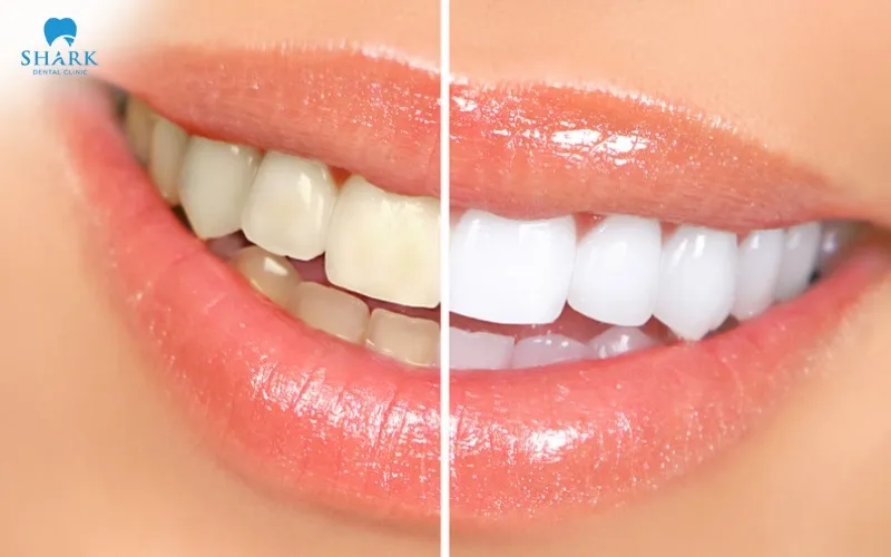 Whitening gel can help improve tooth color and effectively remove stains, giving the teeth a brighter and cleaner-looking appearance