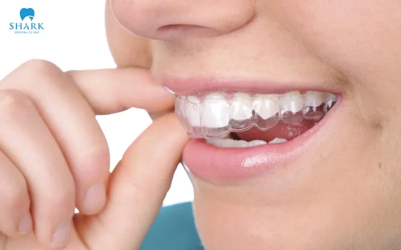 To help the gel work effectively, you need to follow your dentist’s instructions on how long to wear the tray and how to use the product properly throughout the whitening process
