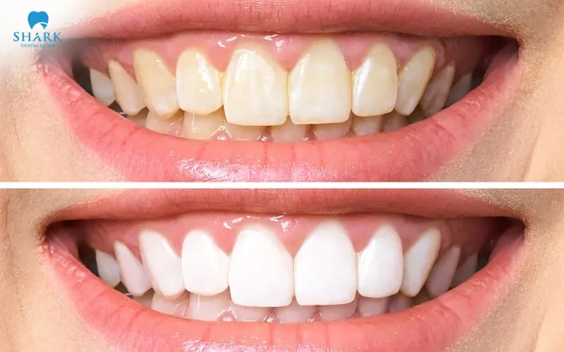 You should limit dark-colored foods and drinks such as coffee, tea, red wine, or colored soft drinks to reduce the risk of the teeth becoming dull or stained again after whitening