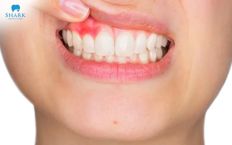 A common side effect when using whitening gel is gum irritation, which may occur when the gel comes into direct contact with the gum tissue during the whitening process