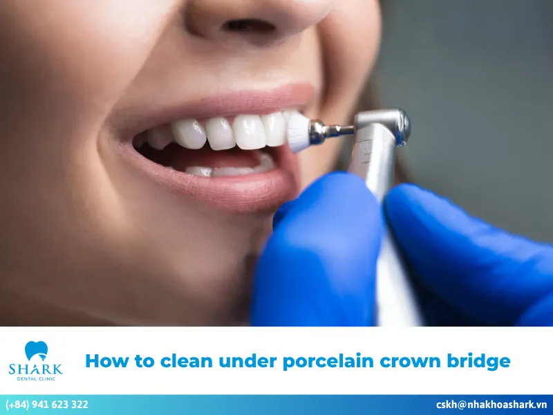 How to clean under porcelain crown bridge: Step-by-step guide