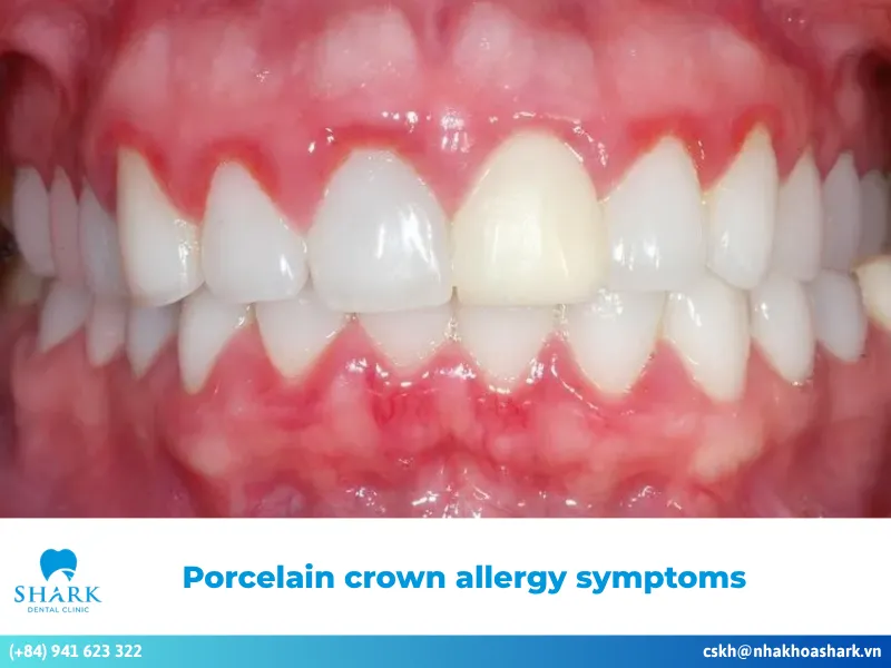 Common porcelain crown allergy symptoms and their causes