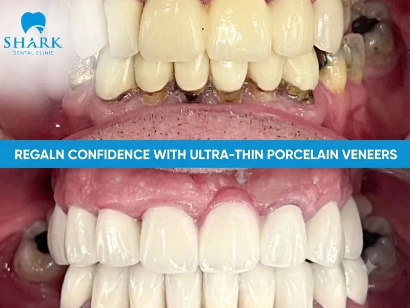 Restoring confidence with ultra thin veneers