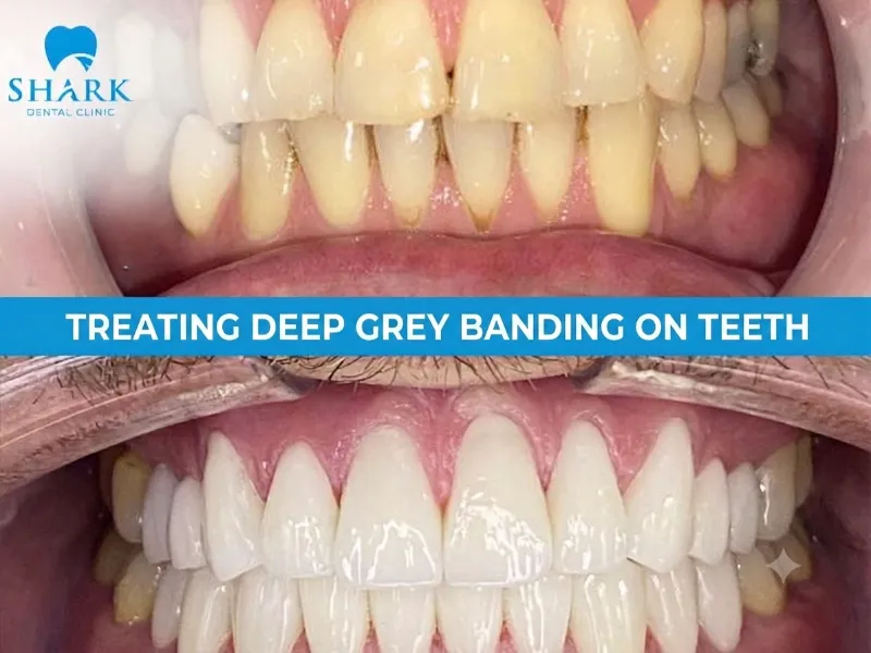 Transforming severe gray banding