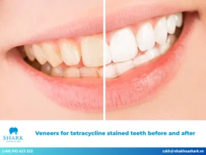 Veneers for tetracycline stained teeth before and after