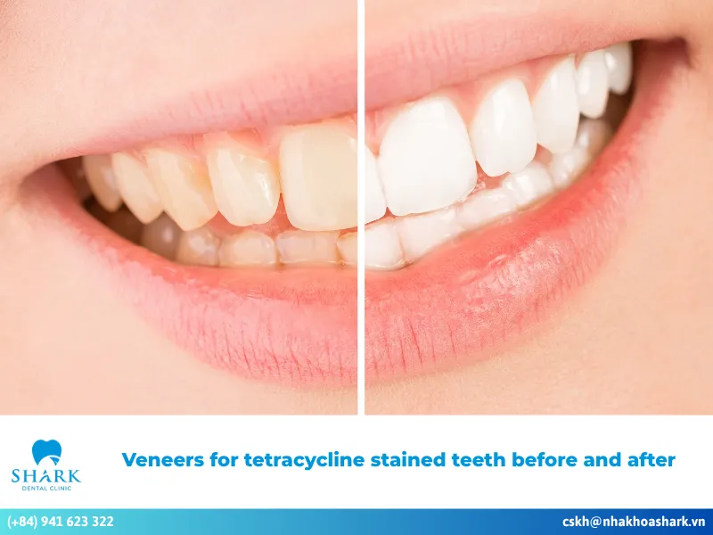 Veneers for tetracycline stained teeth before and after