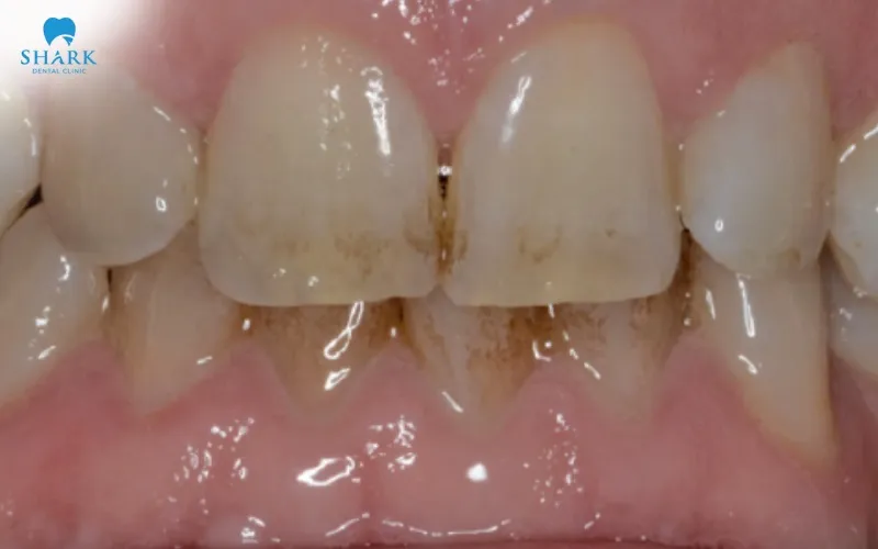 Composite resin can gradually become discolored because of several factors that affect the restoration throughout daily use
