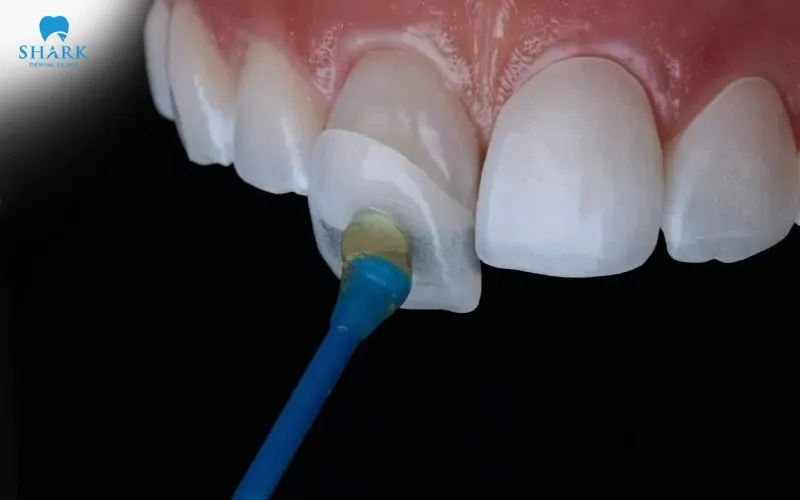 Composite and porcelain veneers can both improve tooth color, but the two materials have clearly different levels of stain resistance
