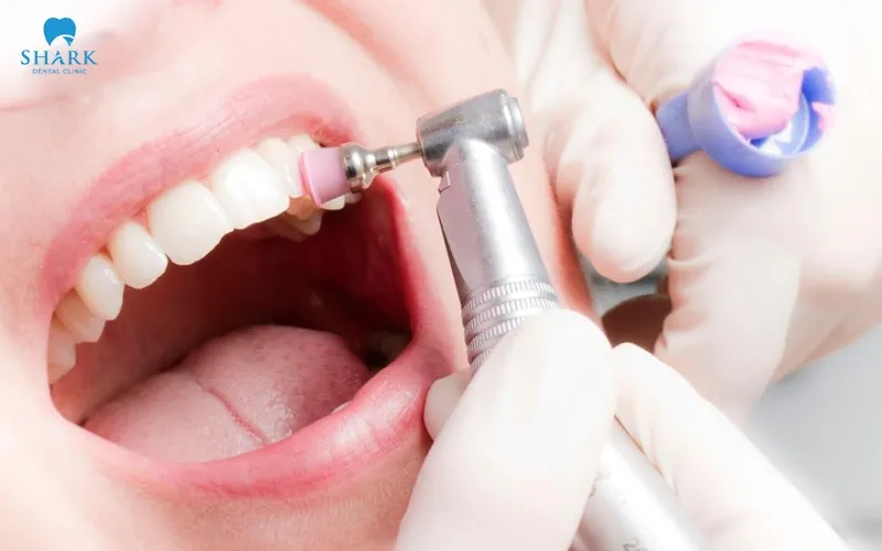 Professional dental polishing is one of the preferred options before considering replacement of a stained composite restoration