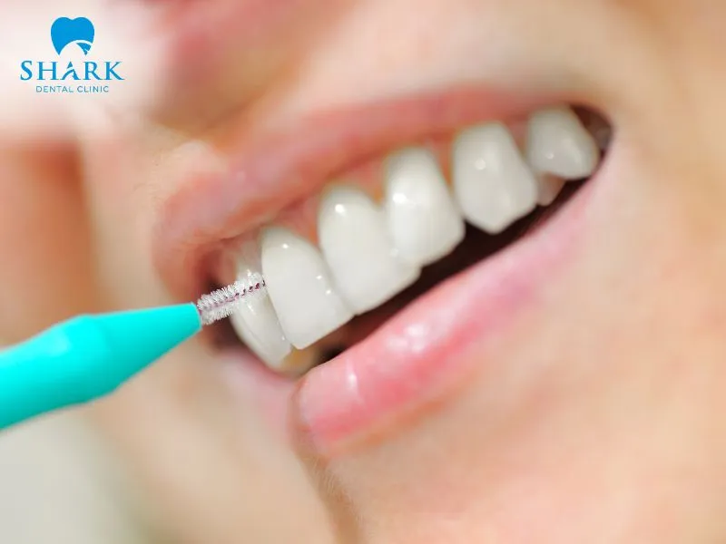 Water flossers and interdental brushes support effective cleaning of the areas beneath porcelain bridges and crowns