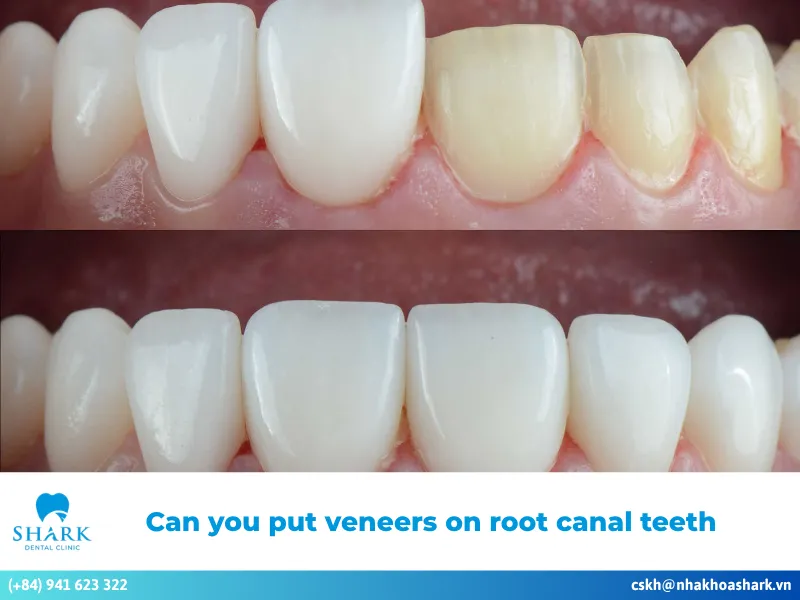 Can you put veneers on root canal teeth, and why?