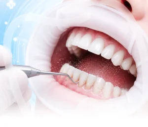 Teeth Scaling and Polishing