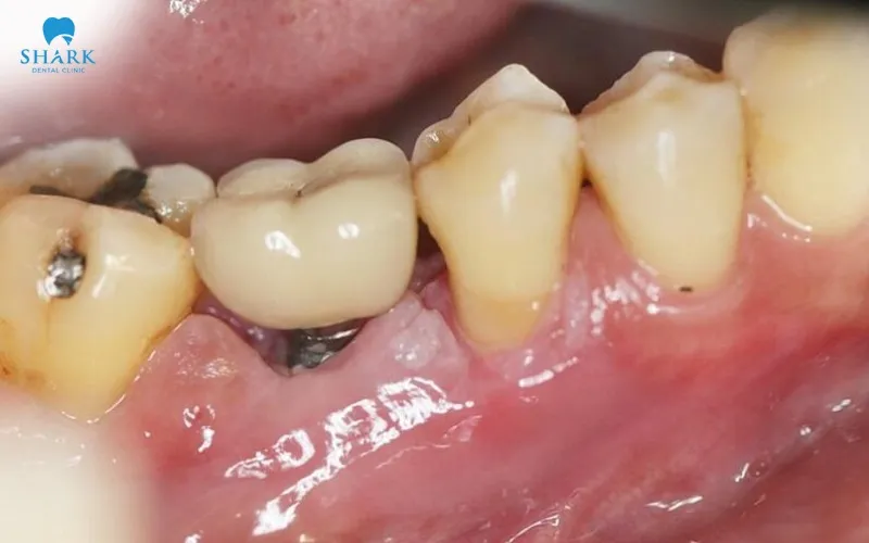 Dental implants do not move during MRI scans