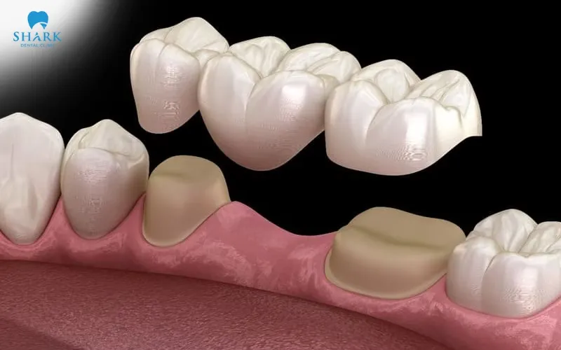 Dental bridges may contain metal components and create localized image artifacts during an MRI examination