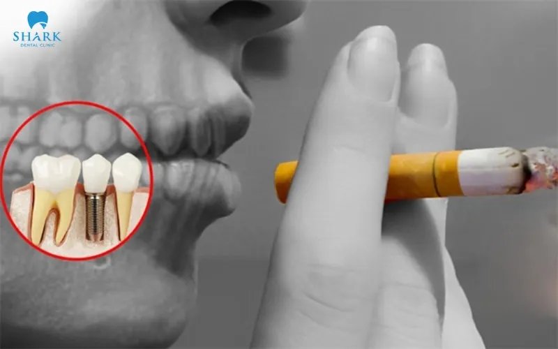 Smoking is considered contraindicated after dental implant surgery