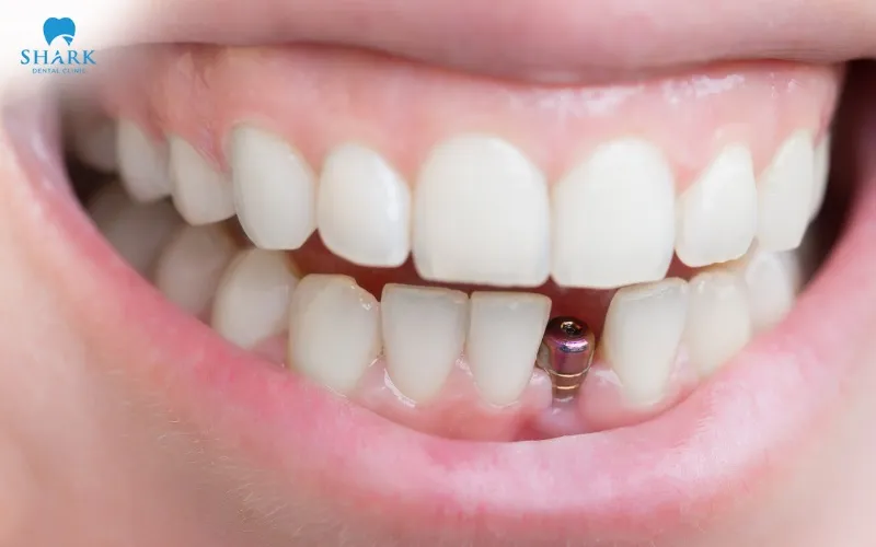 Can you smoke after dental implant