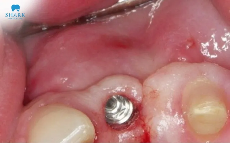 Can you smoke after dental implant