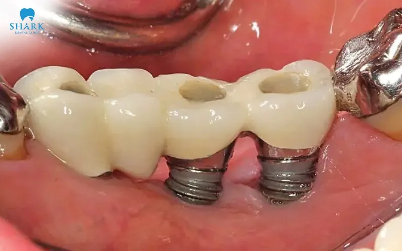 Smoking causes the connection between the jawbone and implant surface to form more slowly, develop less effectively, and remain less secure during the important osseointegration period