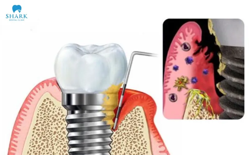 Smoking weakens immune system function and reduces the body’s natural ability to control bacteria and protect the healing tissues around the surgical site