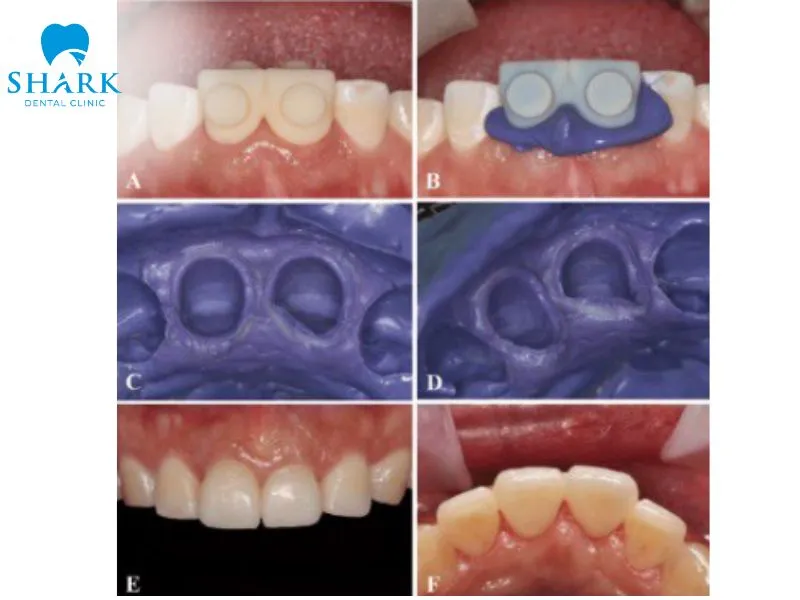 CAD/CAM technology allows dentists to take highly accurate digital impressions of the patient’s teeth and surrounding structures