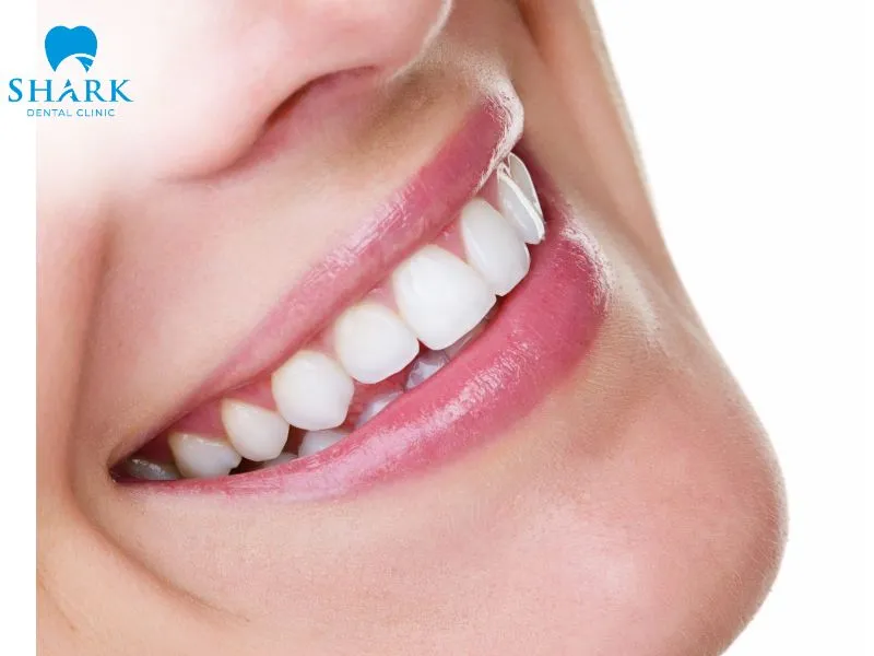 CAD/CAM crowns may be fabricated as monolithic restorations or as milled frameworks with additional veneering, depending on the material and aesthetic requirements