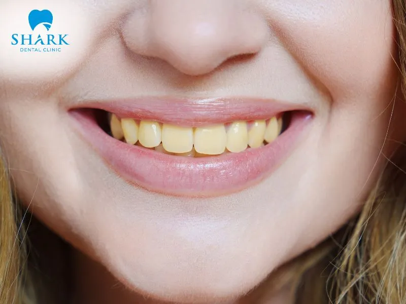 Porcelain crowns are generally preferred when root canal-treated teeth have extensive structural damage or must regularly withstand significant biting and chewing forces