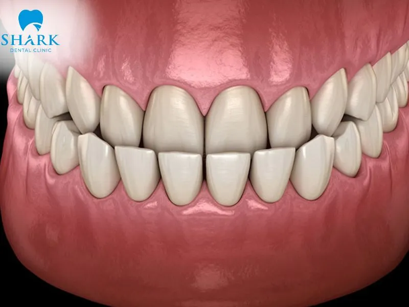 Porcelain veneers may improve mild irregularities involving tooth shape and bite alignment when the natural teeth and roots remain stable