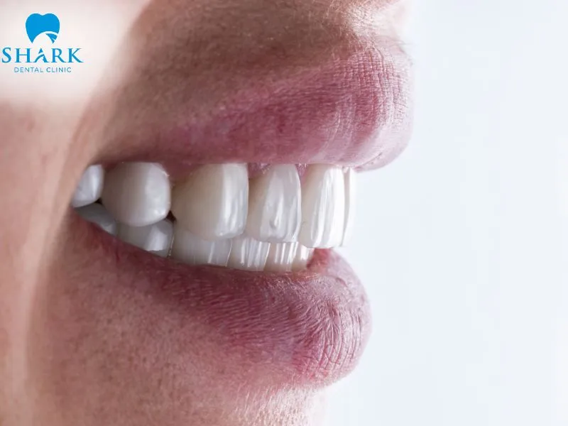 Porcelain veneer treatment provides a quick aesthetic solution for patients with mild bite irregularities who want to improve their smile
